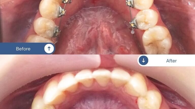 1 リンガル矯正(アーチ改善)