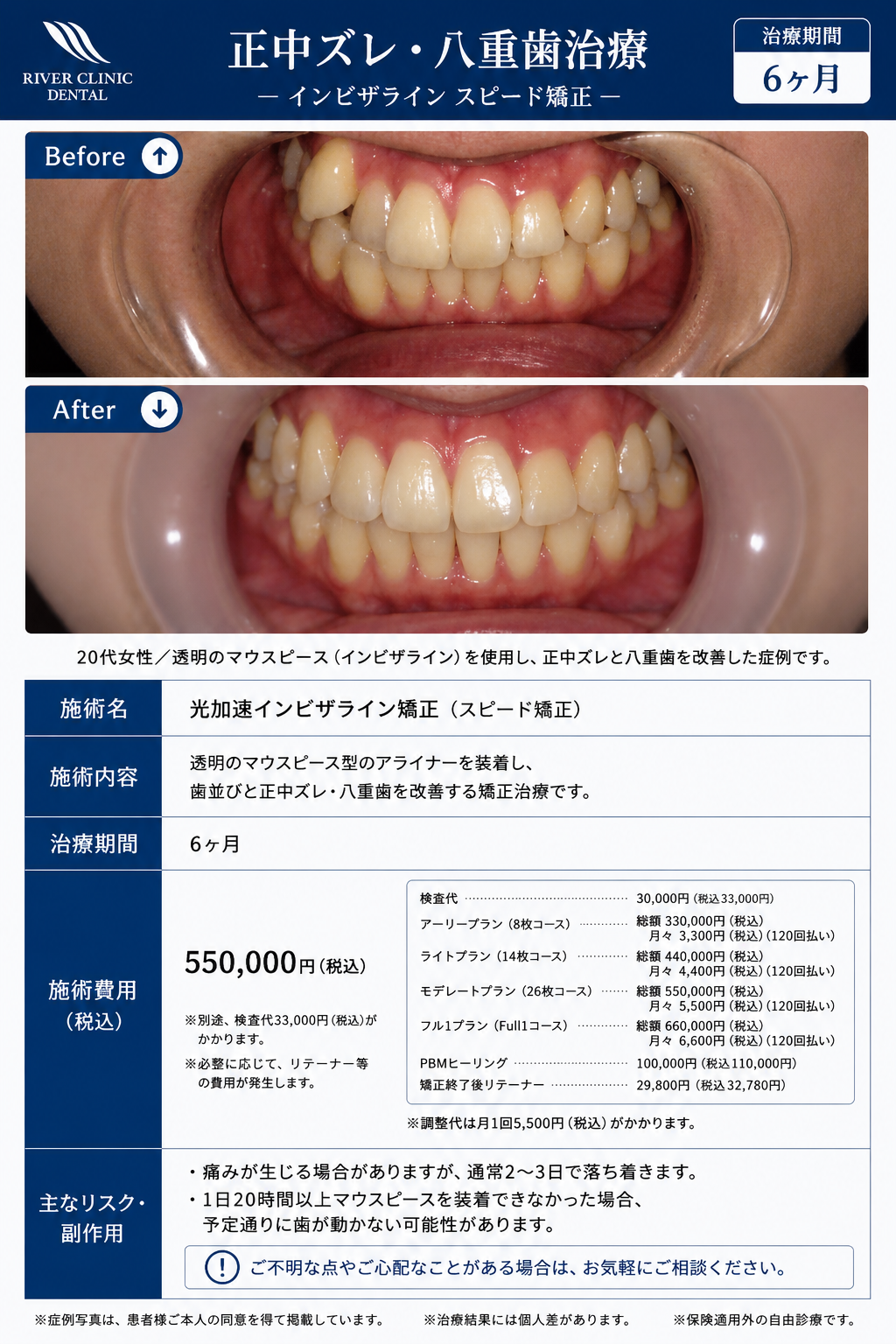 3インビザライン矯正(八重歯治療)　