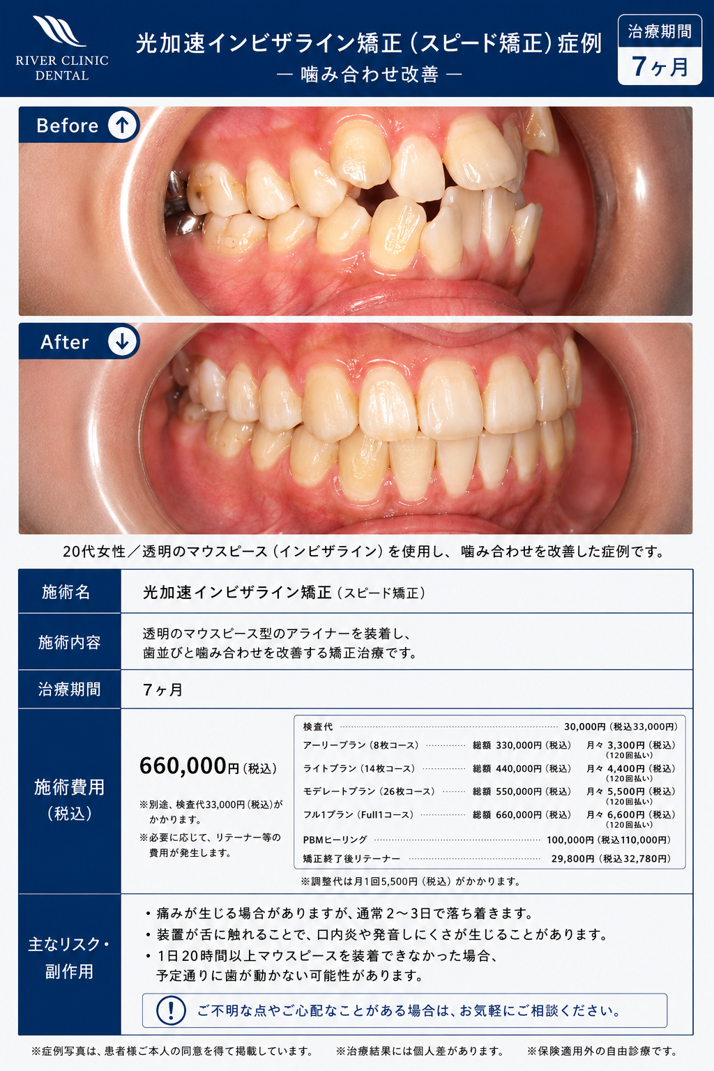 0インビザライン矯正(噛み合わせ改善)　