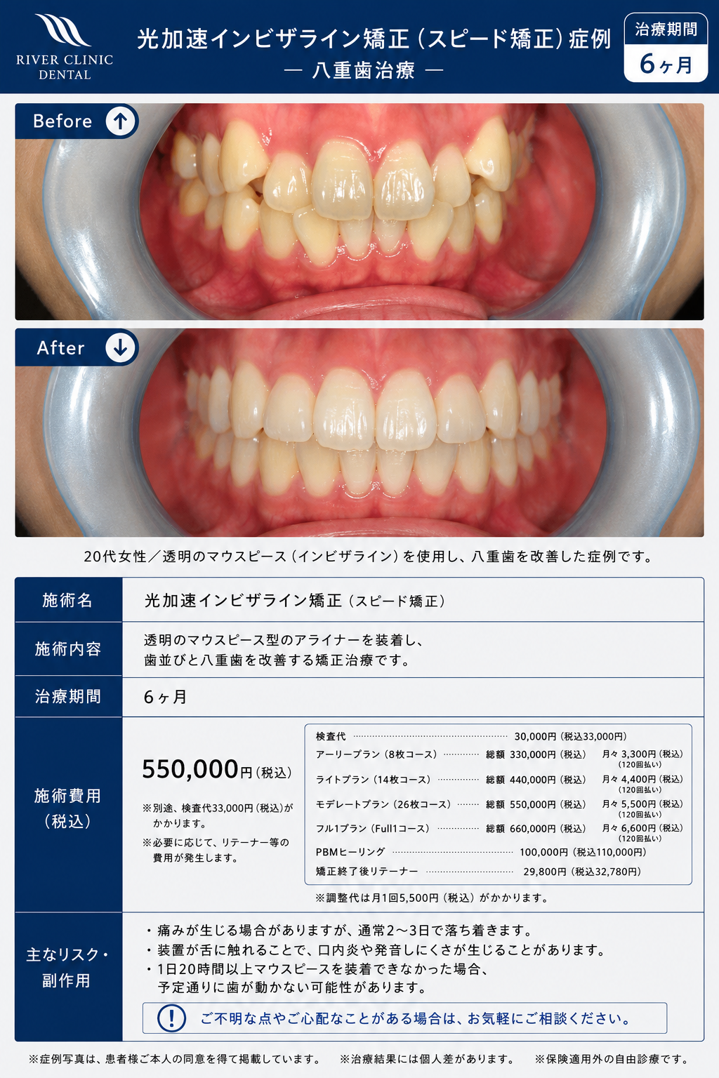2インビザライン矯正(正中ズレ･八重歯治療)　