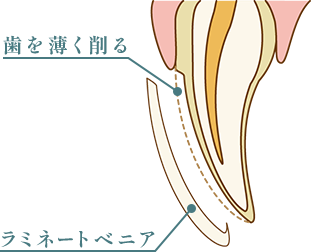 歯を薄く削るラミネートベニア