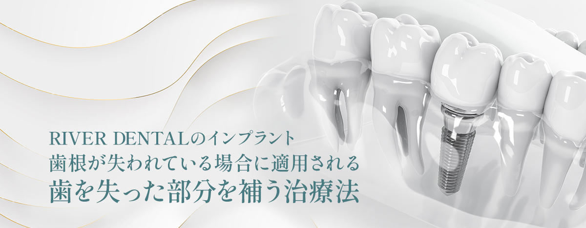 RIVER DENTALのインプラント 歯根が失われている場合に適用される歯を失った部分を補う治療法