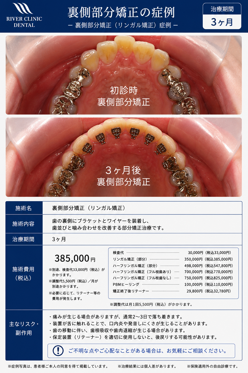 6裏側部分矯正　