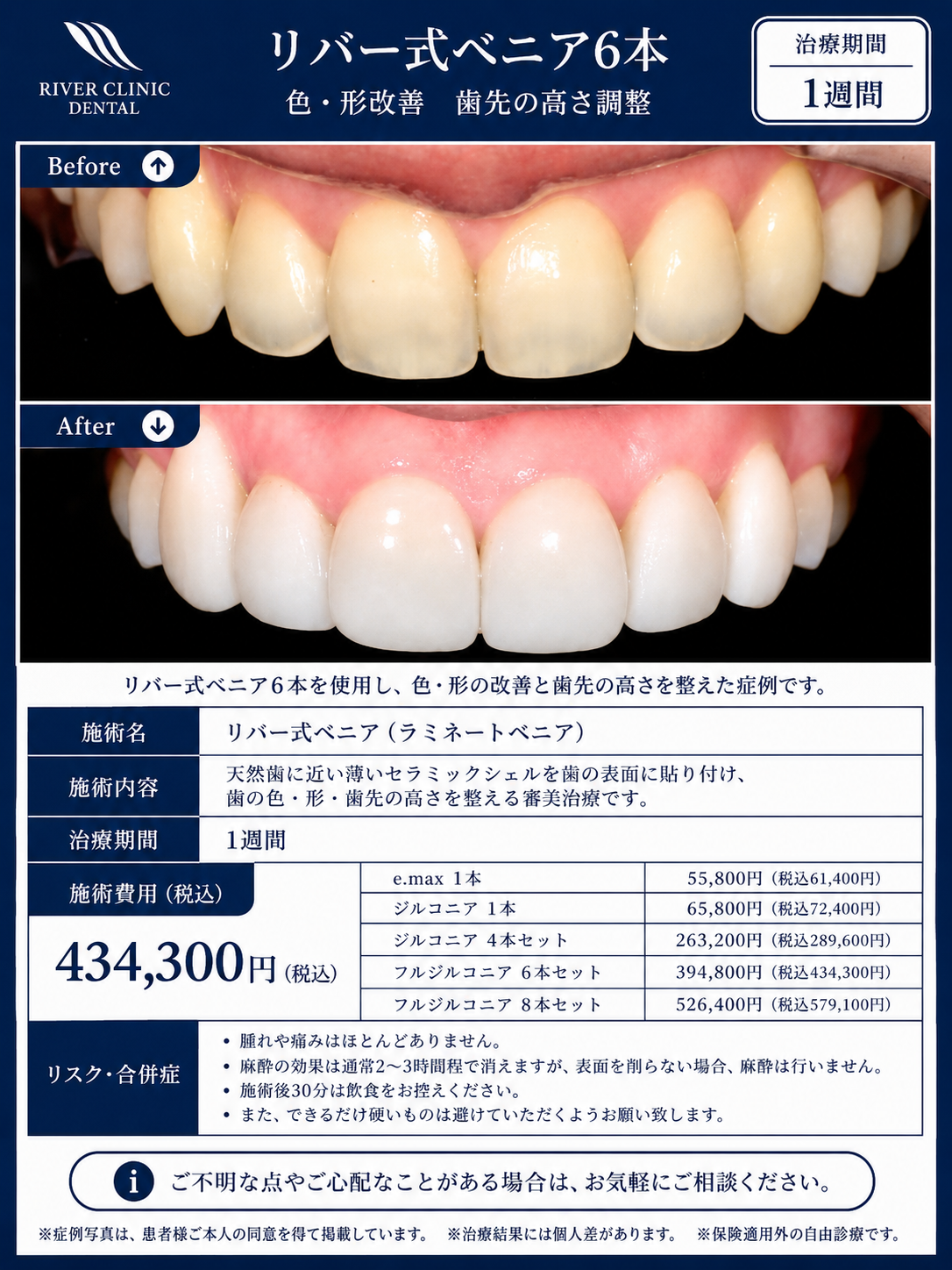 30リバー式ベニア治療(色・形改善、歯先の高さ調整)　