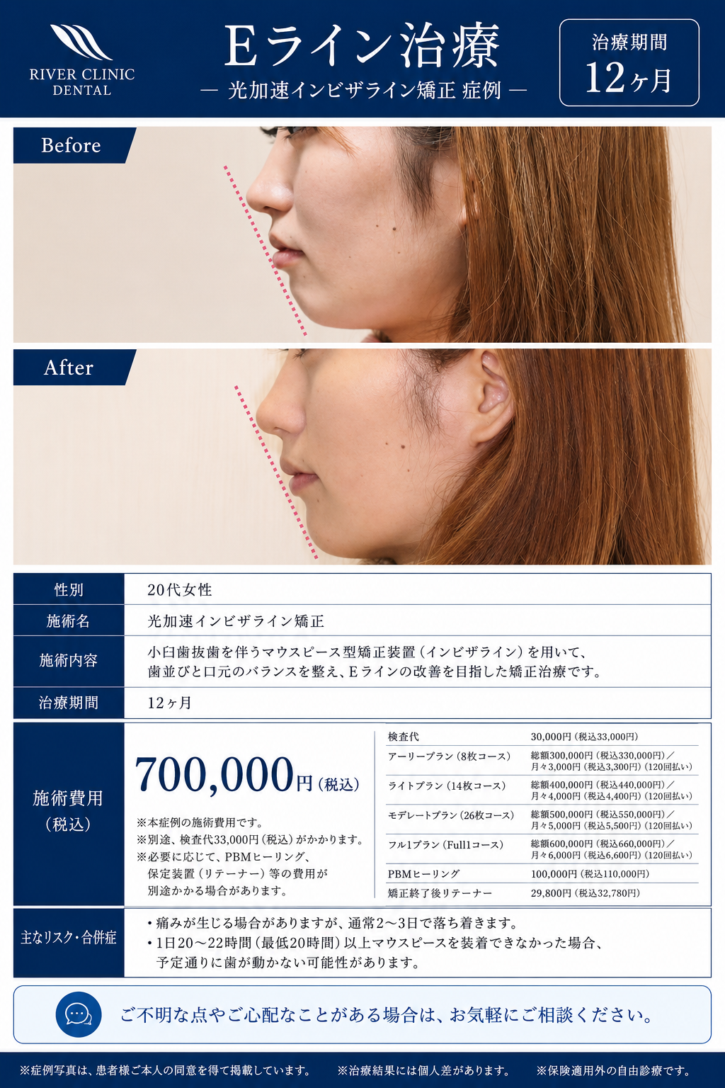 39インビザライン矯正(Eライン治療)　