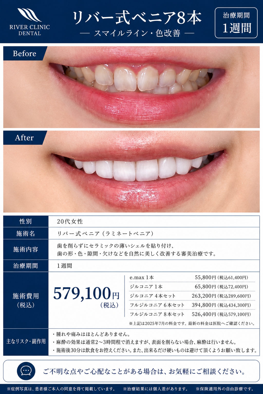 38リバー式ベニア治療(スマイルライン・色改善)　