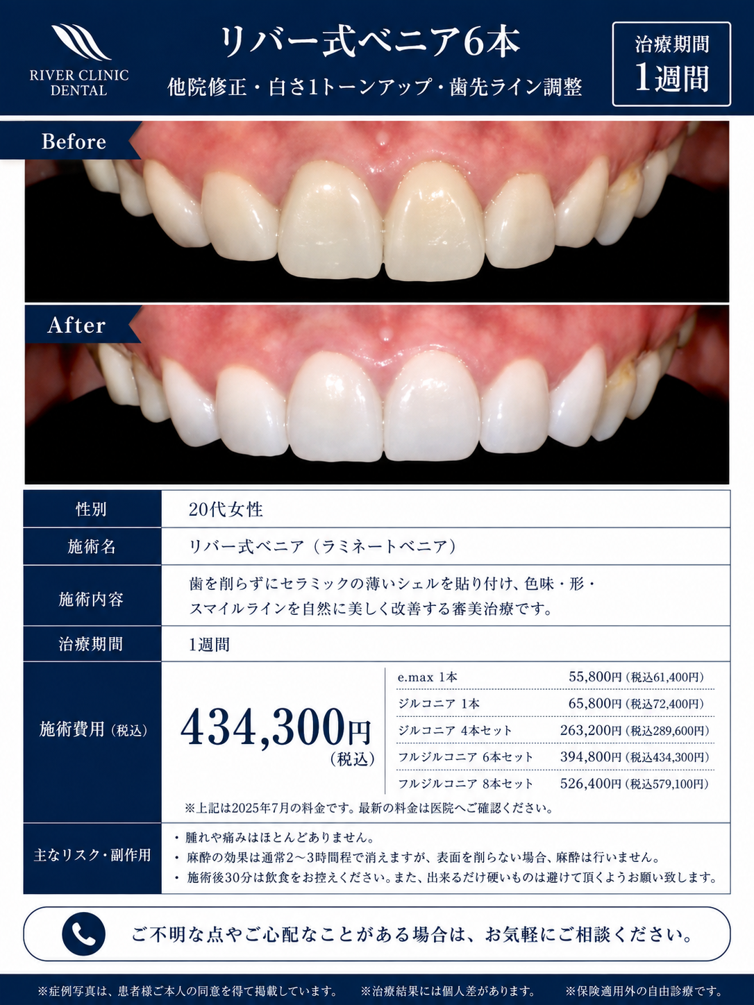 37リバー式ベニア治療(他院修正・白さ1トーンアップ・歯先ライン調整)　
