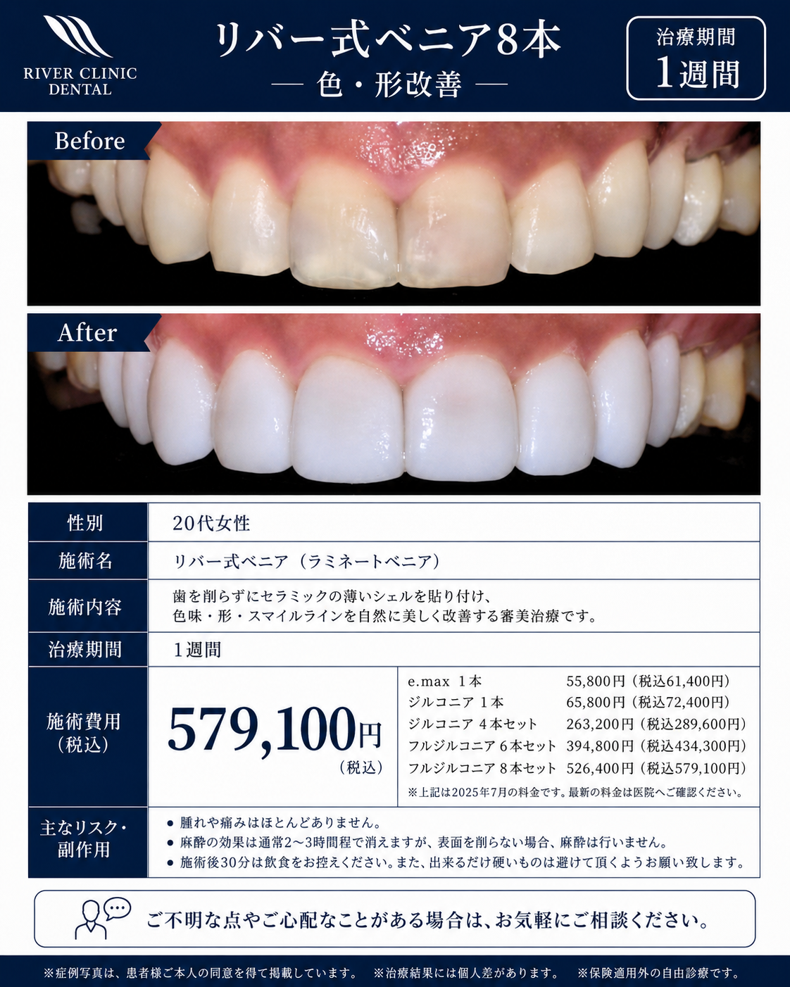 35リバー式ベニア治療(色・形改善)　