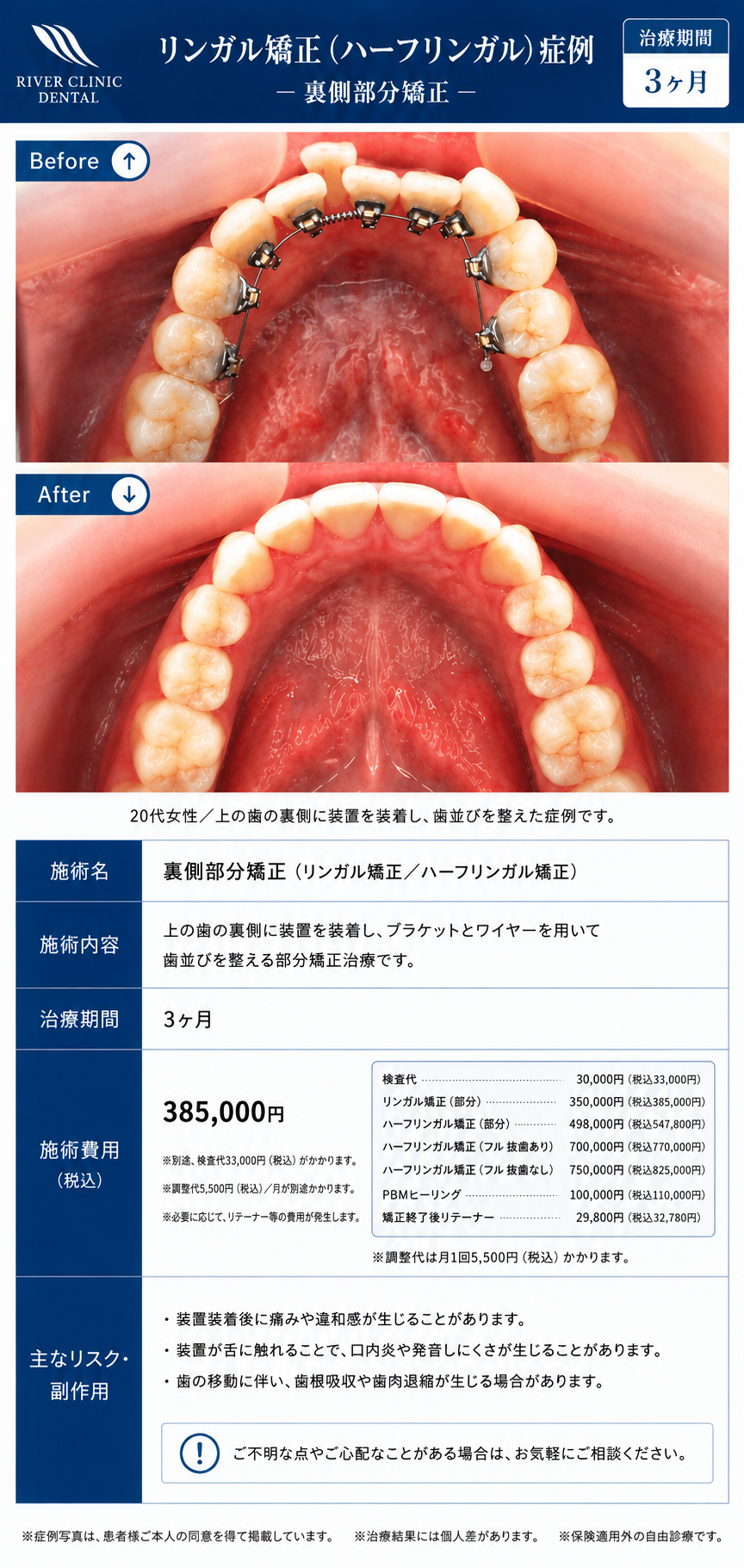 1 リンガル矯正(アーチ改善)