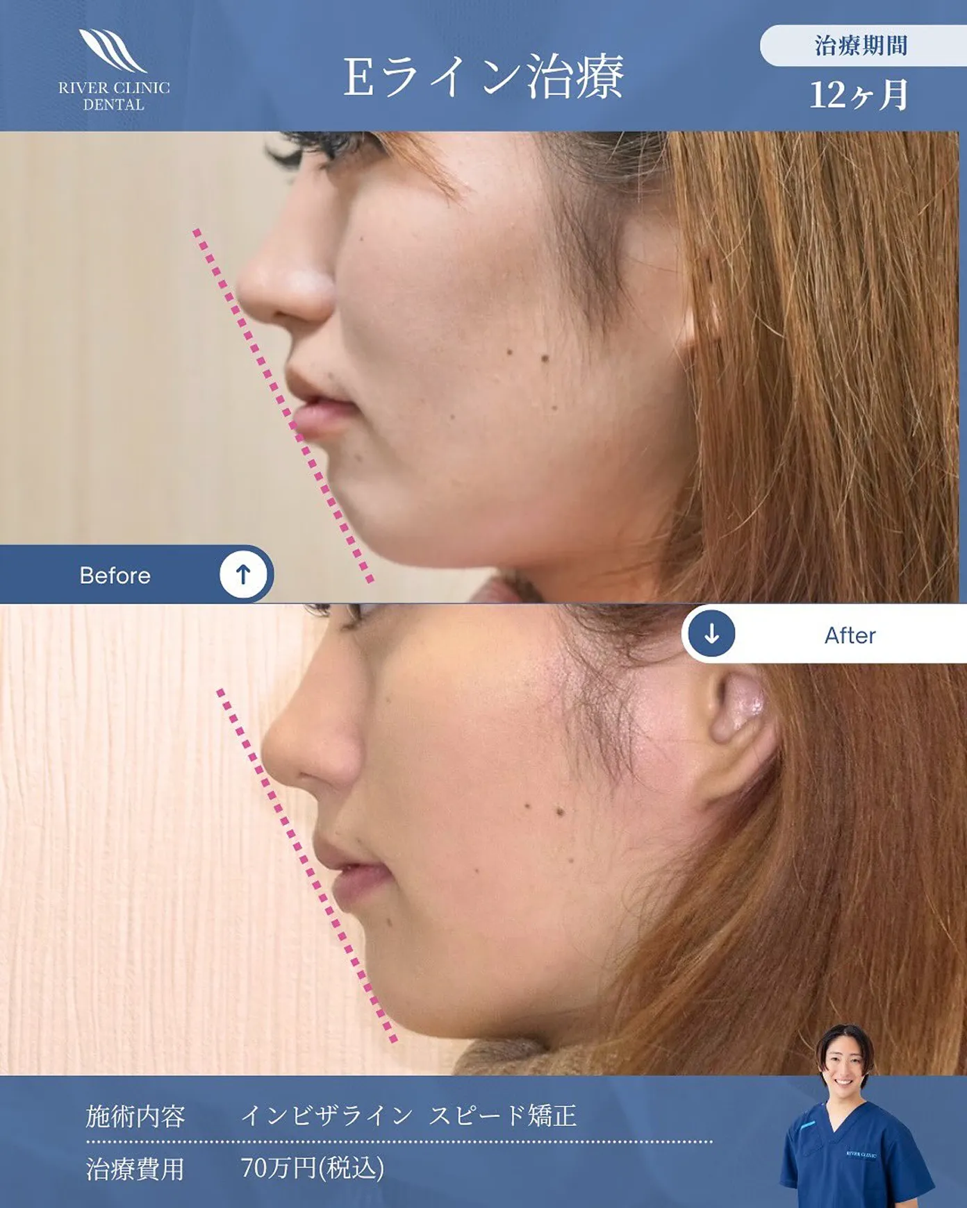 Eライン治療の症例(Before/After) 治療期間12ヶ月