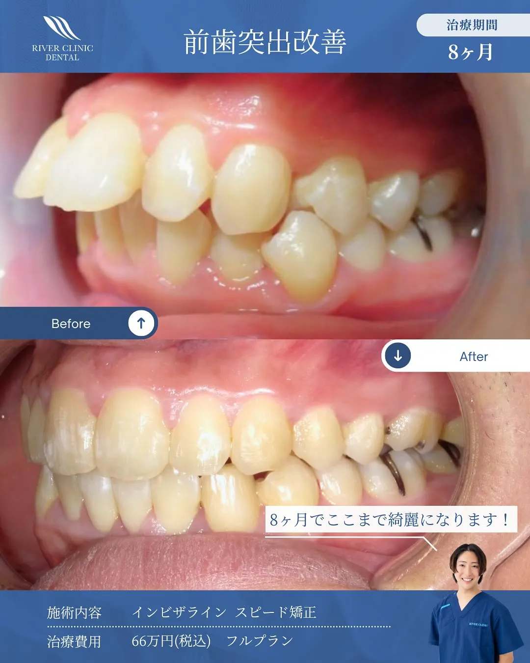 前歯突出改善の症例(Before/After) 治療期間8ヶ月