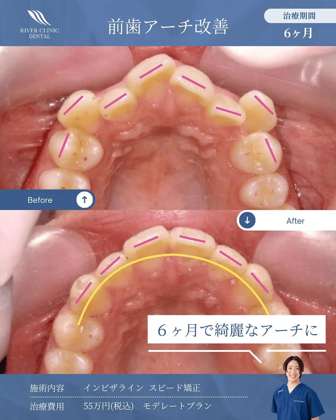 前歯アーチ改善の症例(Before/After) 治療期間6ヶ月