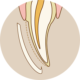 リバー式ベニア(ラミネートベニア)