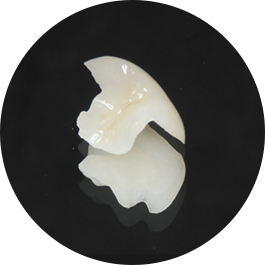 インレー(詰め物)