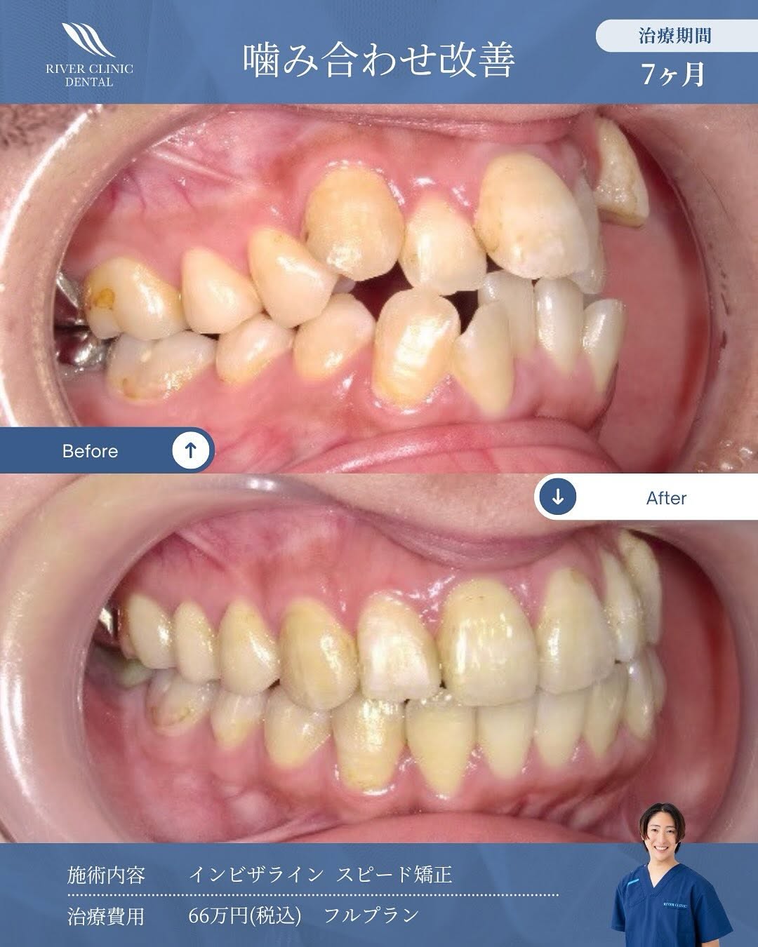 叢生（歯のガタつき）はインビザラインで治る？適応条件と治療の流れ