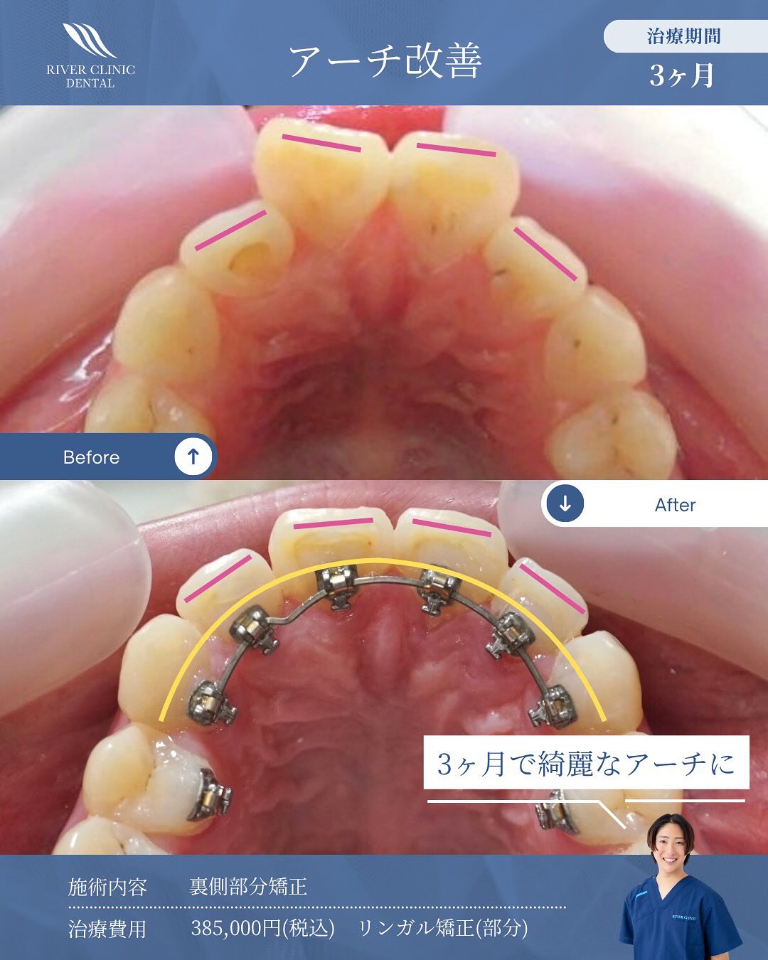光加速矯正の効果とは？治療期間を短縮する仕組みと実際の変化を解説