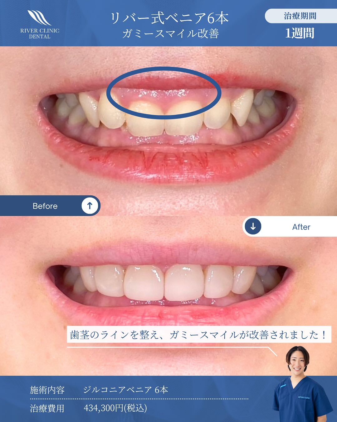 ガミースマイルの原因とは？歯・骨格・筋肉から見る3つのタイプを解説