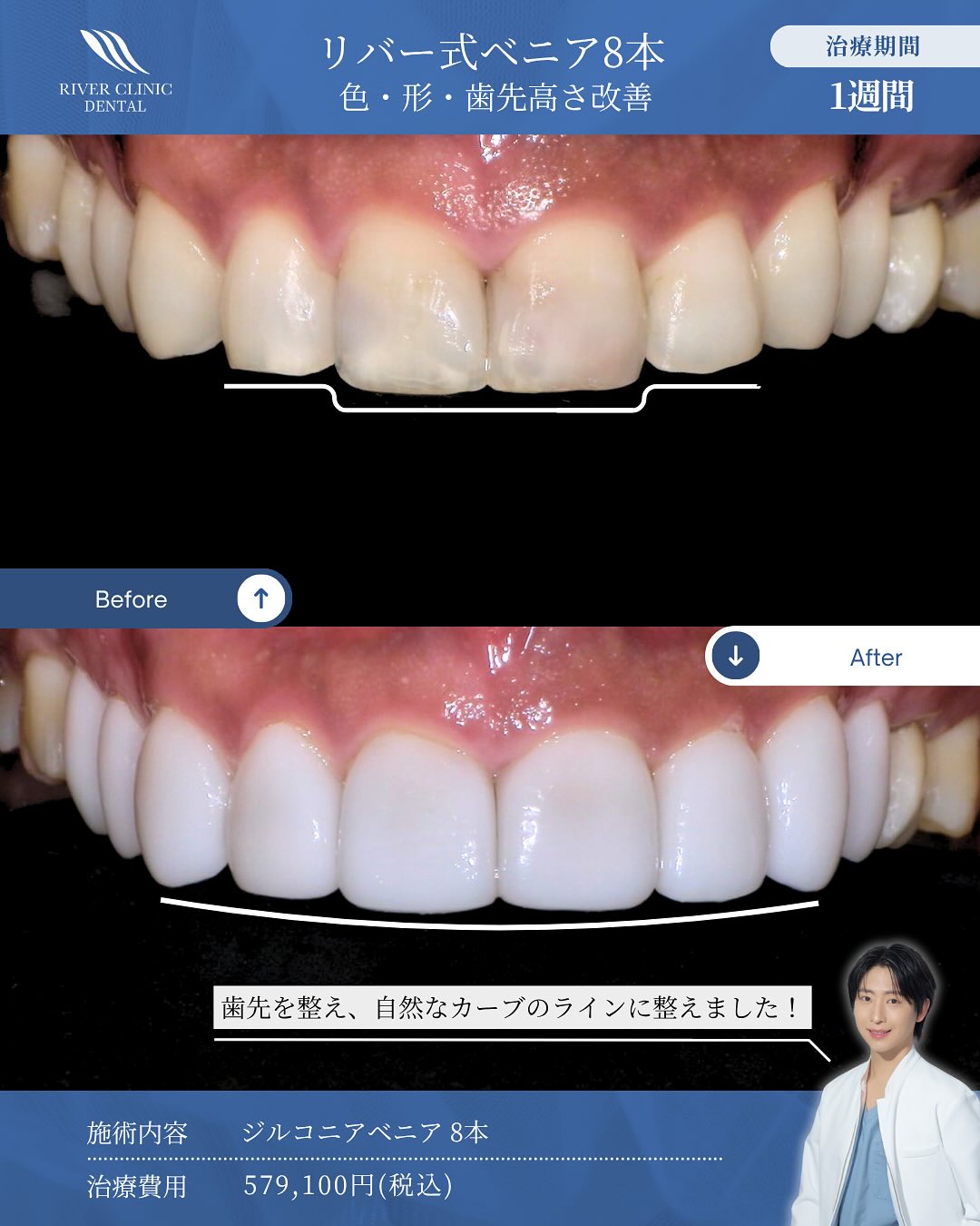 ラミネートベニアの値段相場は？1本あたりの費用と選び方を解説