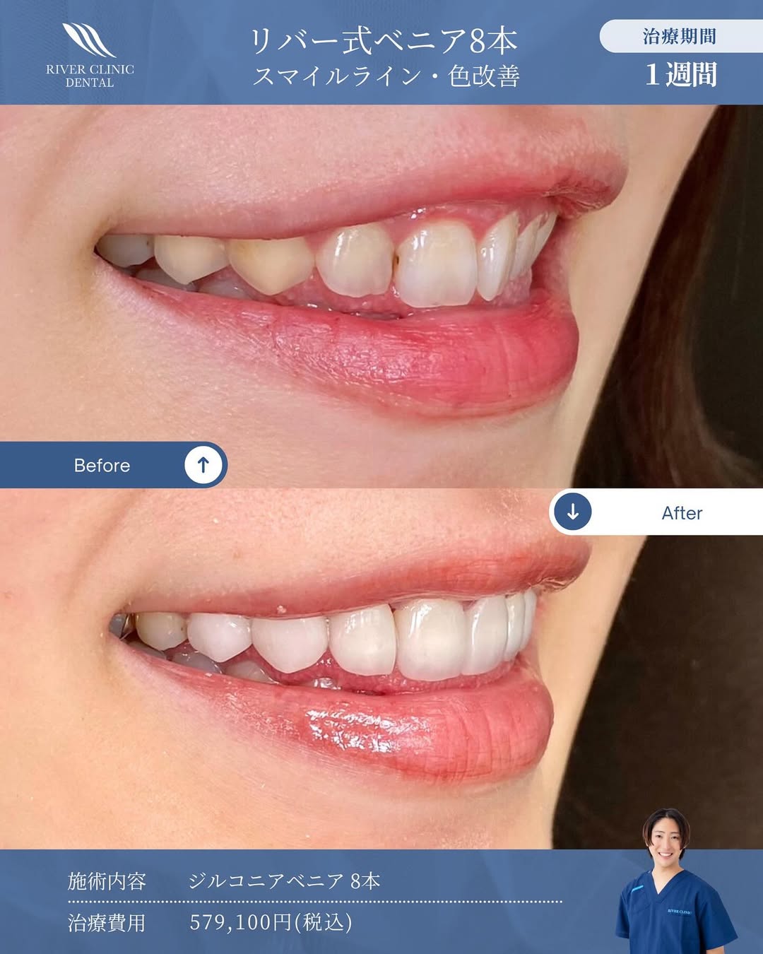 ラミネートベニアは即日可能？最短治療期間と通院回数を解説