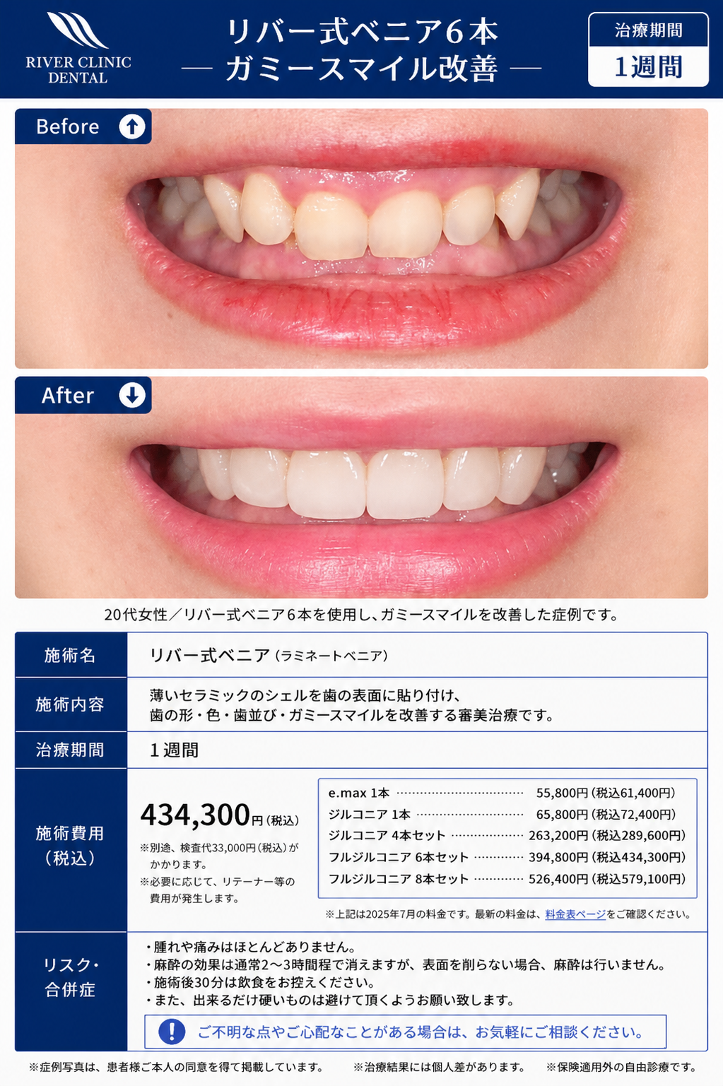 29リバー式ベニア治療(ガミースマイル改善)　