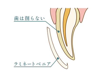 歯を削らない治療も可能