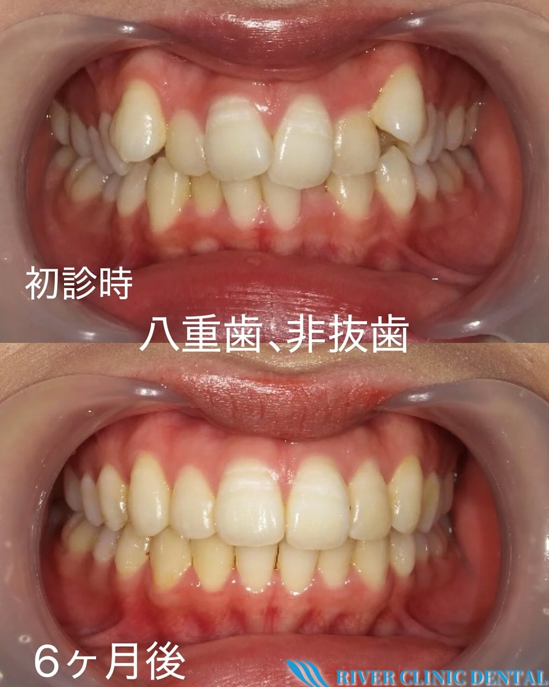 10インビザライン矯正(八重歯治療)　