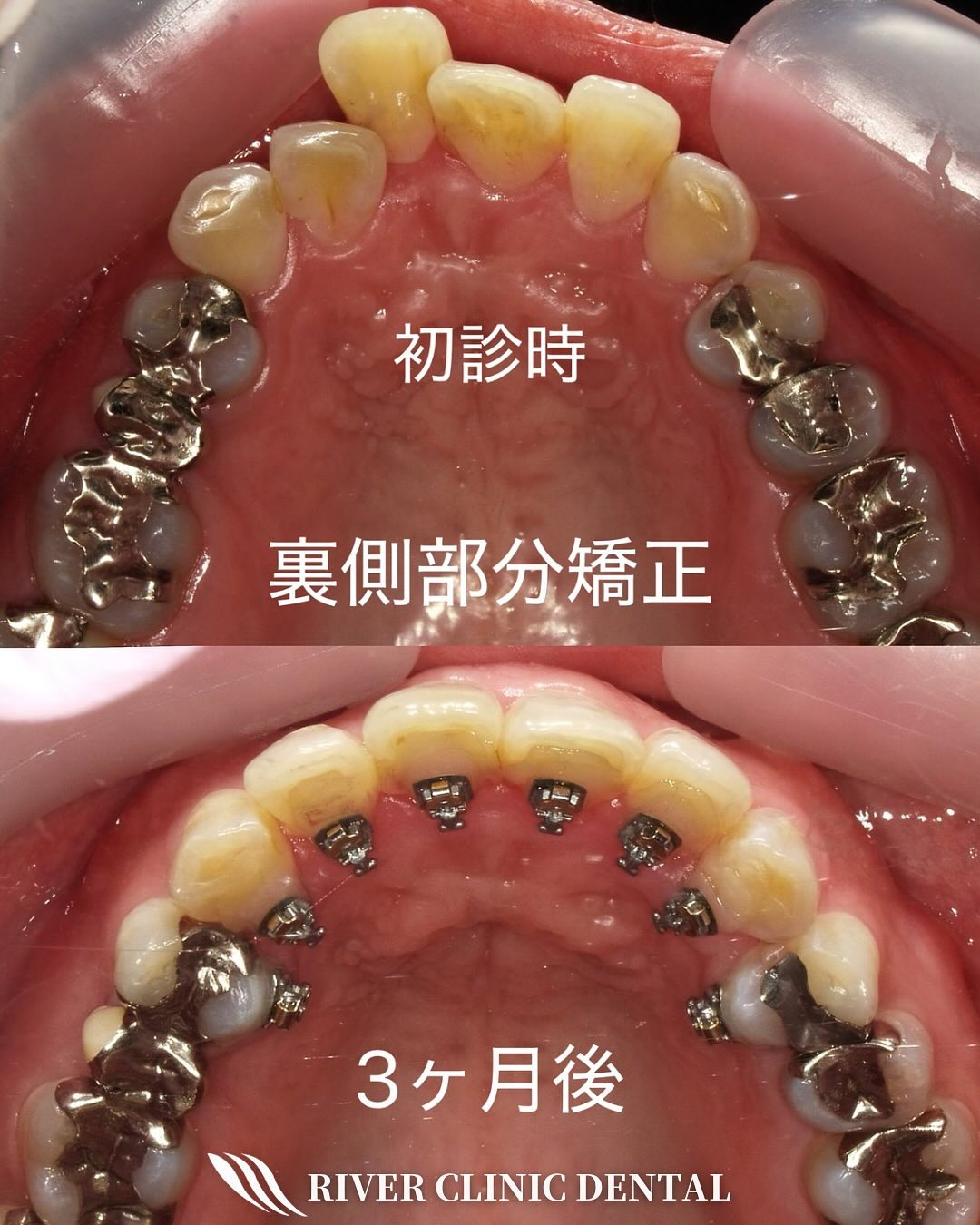 6インビザライン矯正(裏側部分矯正)　