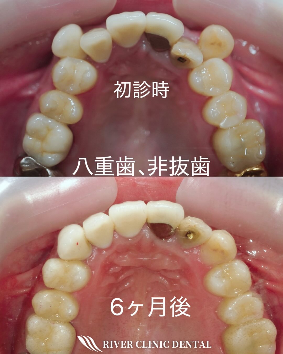8インビザライン矯正(八重歯治療)　
