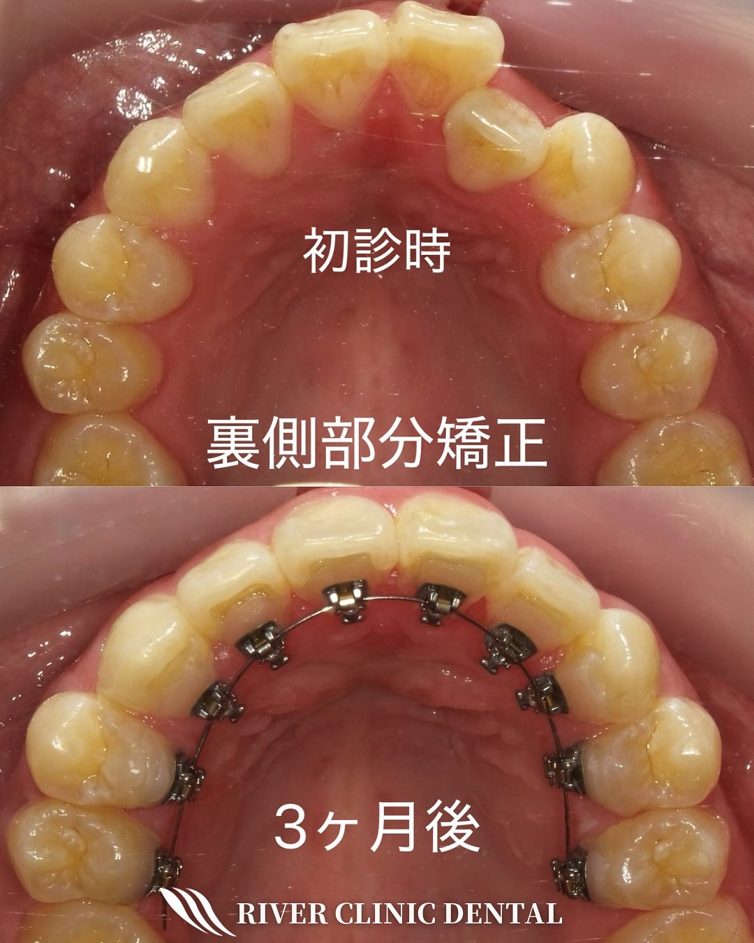 9インビザライン矯正(裏側部分矯正)　